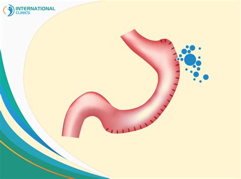 signs of gastric sleeve leak|Signs and Symptoms of Gastric Sleeve Leak